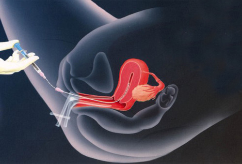 Female Uttarbasti Treatment