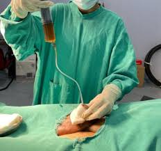 Male Uttarbasti Treatment