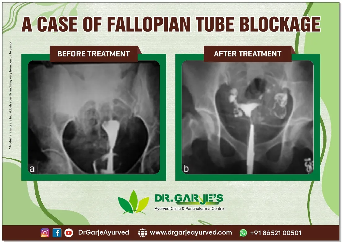 A Case Of Fallopian Tube Blockag
