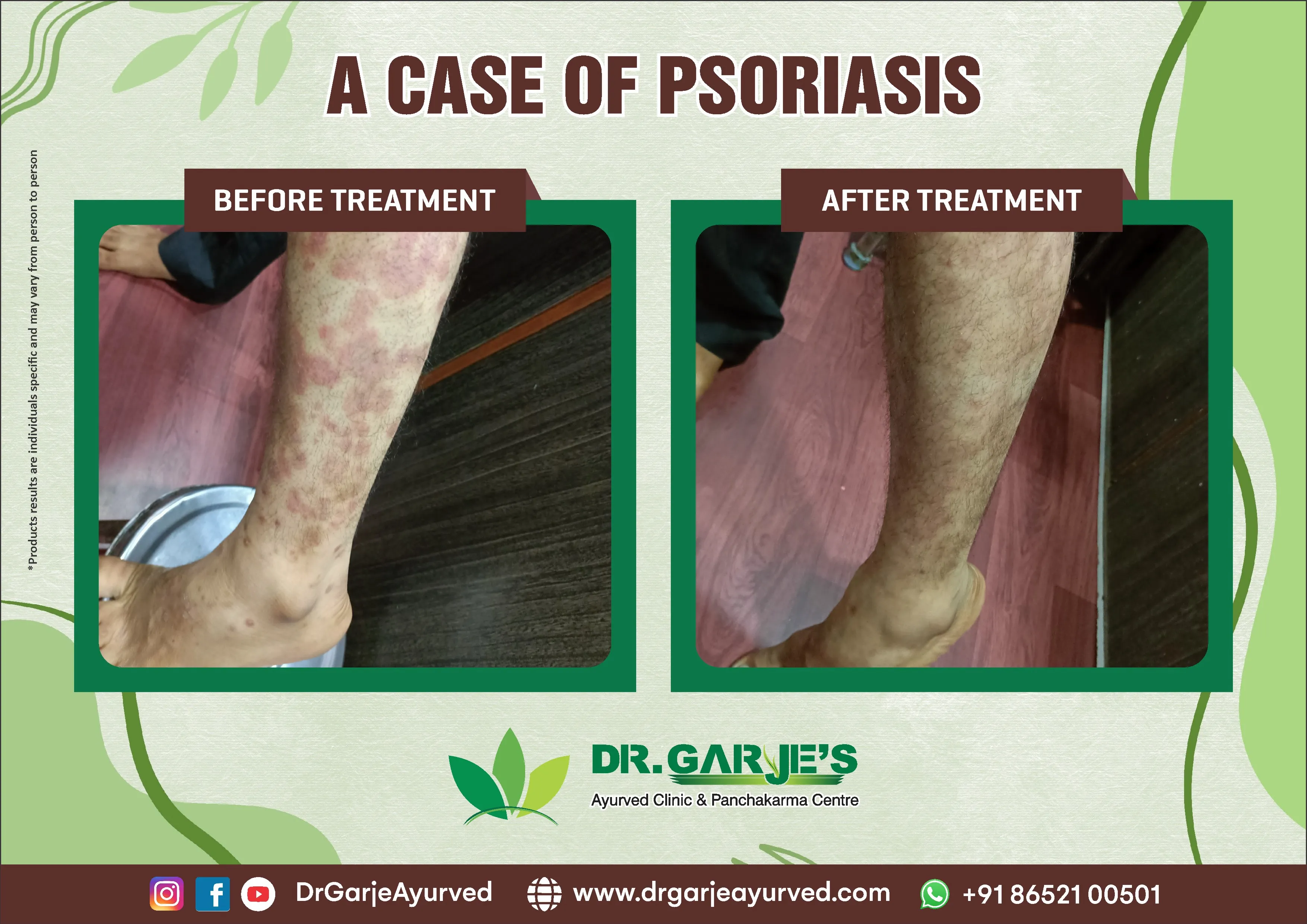 A Case of Psoriasis