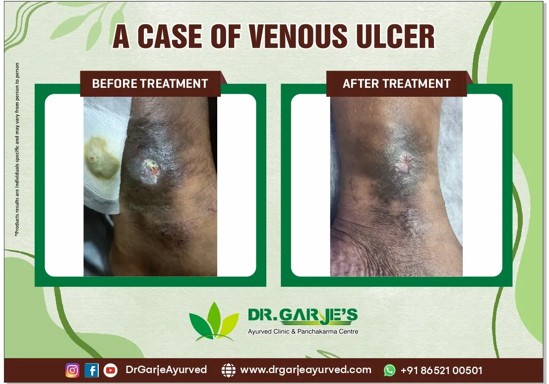 A Case of Venous Ulcer