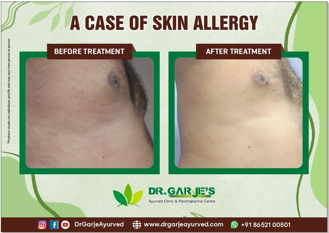 A Case of Skin Allergy