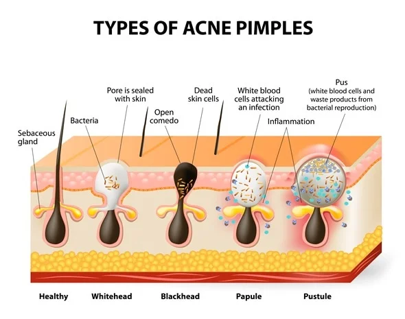 Types_of_acne_shutterstock