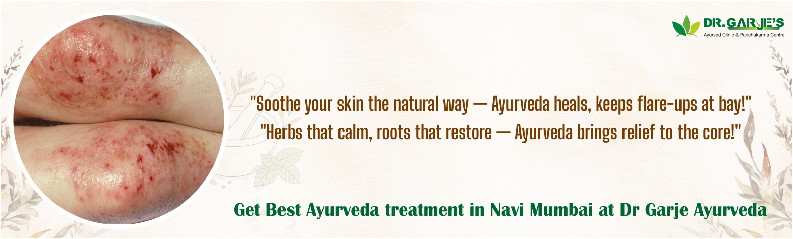  Eczema Treatment at Dr. Garje Ayurved Panchakarma Clinic