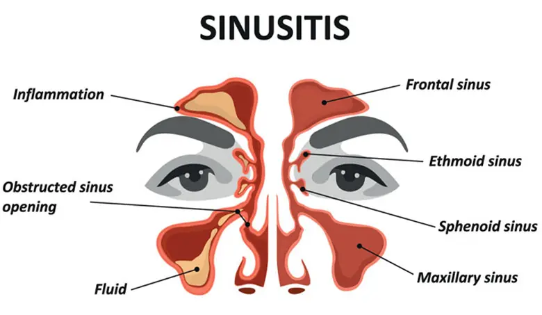 Sinusitis