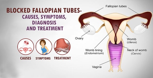Fallopian-Tube-Blockage-Treatment-Without-Surgery