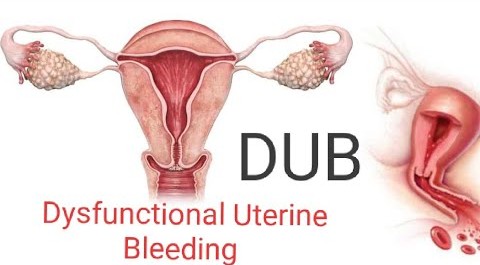 Dysfunctional Uterine Bleeding