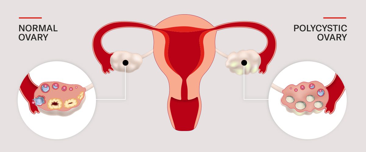 what-is-polycystic-ovary-syndrome-pcos-hero